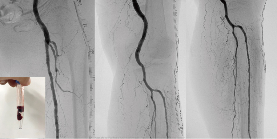 02急性下肢閉塞_after