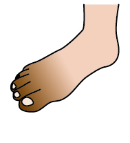 下肢閉塞性動脈硬化2