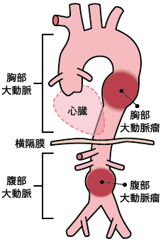 大動脈瘤