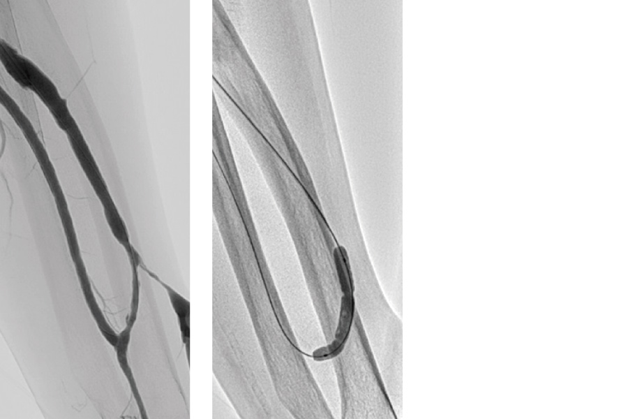 通常のバルーン