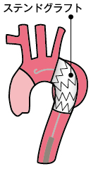 ステンドグラフト_胸部