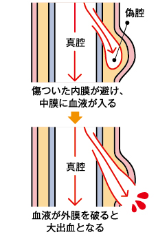 大動脈解離の進行
