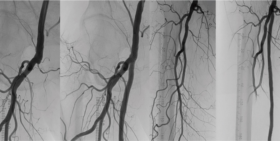 大腿動脈の血栓閉塞