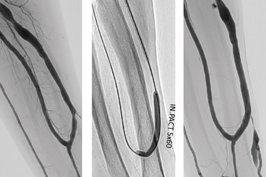 薬剤バルーン