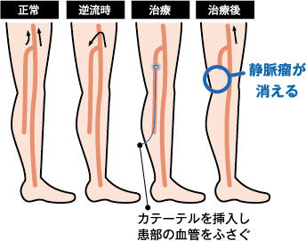 カテーテル焼灼
