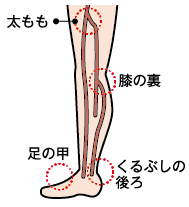 下肢閉塞性動脈硬化1